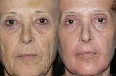 Fraxel Laser Treatment at USHR Spa advance technology reduces age.