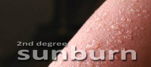 Second degree sunburn is a serious condition.