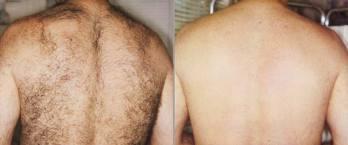 Laser Hair Removal Treatment for Men