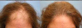 Advance Female Pattern Baldness successfully treated by Parsa Mohebi, MD through FUT hair transplant surgery.