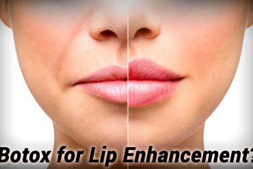 Lip Enhancement with Botox
