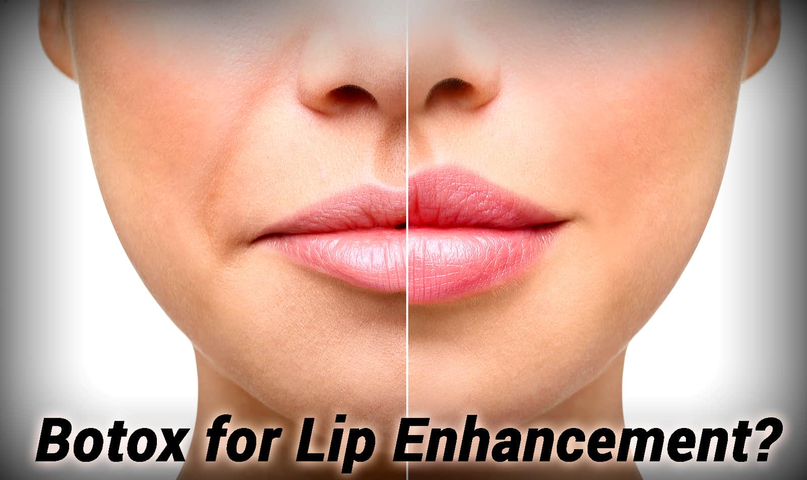 Lip Enhancement with Botox