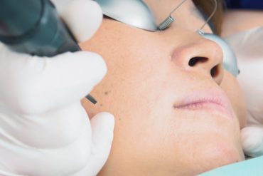 Laser Skin Resurfacing