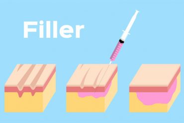 Fat Grafting and Dermal Fillers