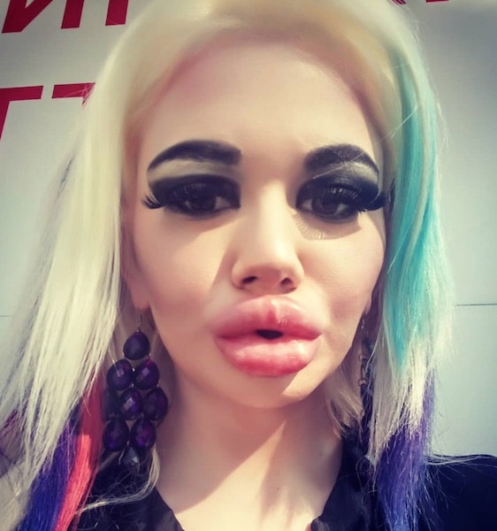 Woman with over 10 lip fillers