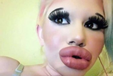 Woman with 15 lip filler procedures