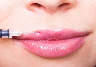 What to expect getting lip fillers